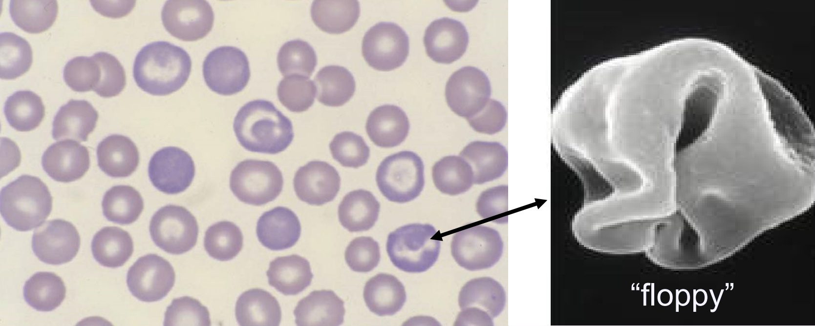 <ul><li><p>describes <strong>blue-purple</strong> color of reticulocytes on a blood smear stained with Wright’s stain or Diff-quick</p><ul><li><p>lack nucleus but retain <strong>ribosomes</strong> that stain blue &amp; blend with salmon color of hemoglobin</p></li></ul></li><li><p>variable central pallor size/shape or absent</p></li></ul><p></p>