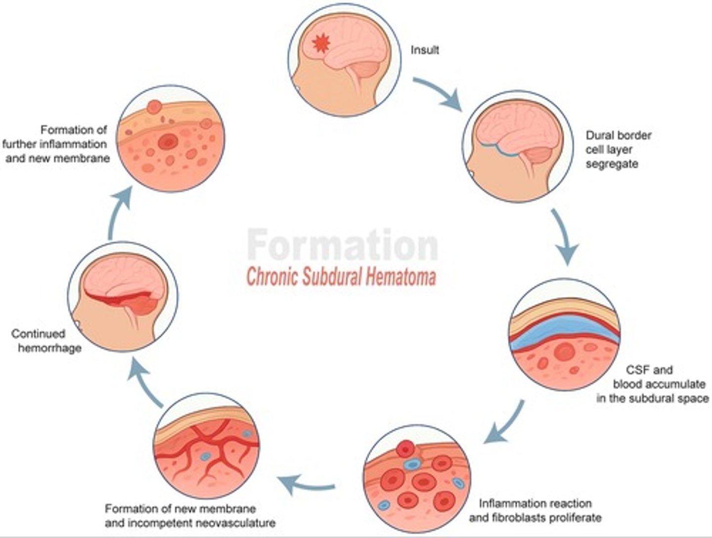 <p>- banaal trauma -> kleine sd bloeding</p><p>- vliezen rond bloeding -> neovascularisatie -> lekken SD</p><p>- uiteindelijk massa effect</p>