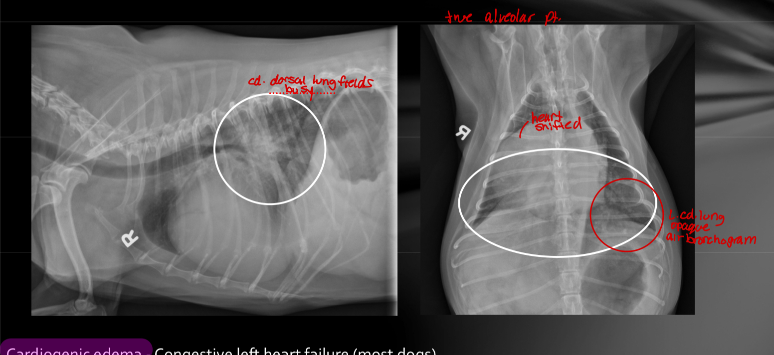 cardiogenic edema