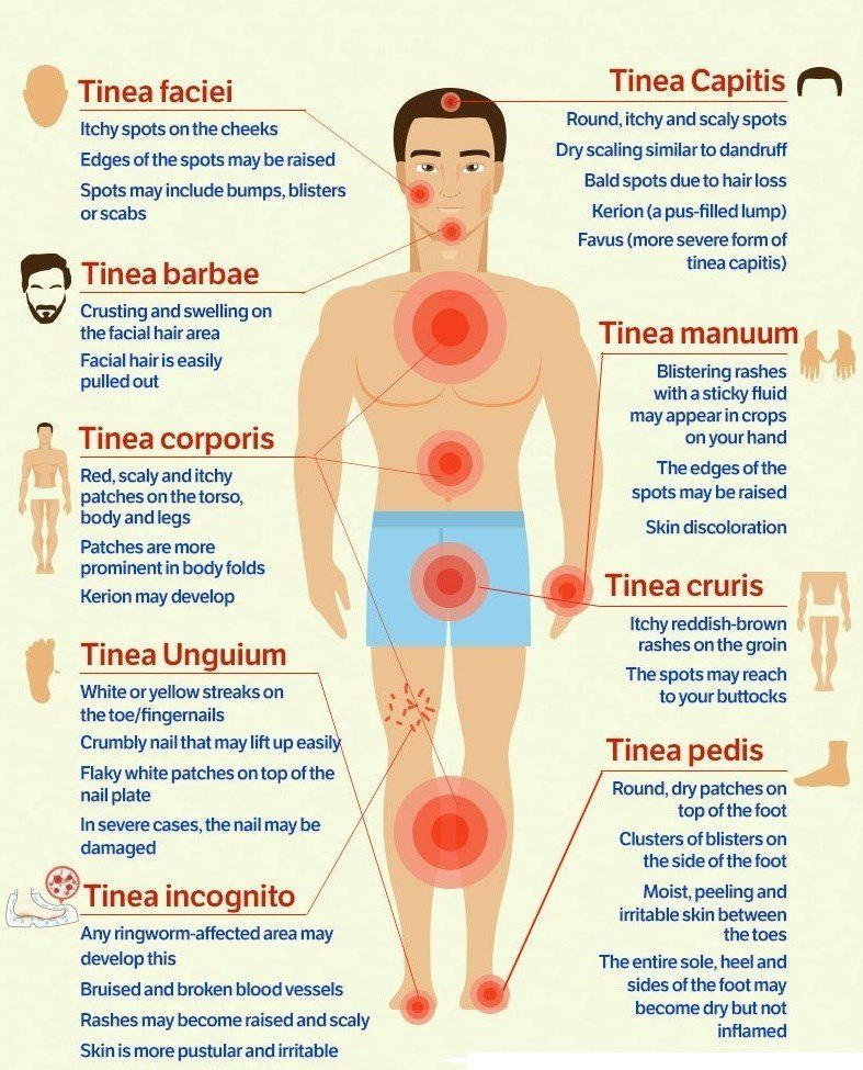 <p>A fungal infection that causes a red, itchy rash in affected areas. Ringworm; includes several types: pedis (foot), capitis (scalp), corporis (body), cruris (jock itch).</p>