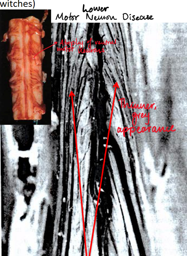 <p>Progressive neurological disorder causing selective degeneration of motor neurons responsible for voluntary muscle activity</p><p><u>Pathogenesis</u>:</p><ul><li><p>Poorly understood, related to superoxide dimutase (SOD1) mutations on chromosome 21 causing neural inclusions and cytotoxicity</p></li><li><p>LMN disease: atrophy of ventral spinal nerve roots causing skeletal muscle denervation</p></li><li><p>UMN Disease: degeneration of corticospinal tracts in lateral portion of SC</p></li></ul><p></p><p><u>Signs</u>:</p><ul><li><p>LMN disease: weakness, fasciculations</p></li><li><p>UMN disease: paresis, hyperreflexia, spasticity, +ve babinski sign</p></li></ul><p></p><p><u>Clinical progression:</u></p><ul><li><p>Increasing muscle weakness and decrease in muscle bulk</p></li><li><p>Difficulty in deglutition and speaking</p></li><li><p>Recurrrent chst infection (main cause of death)</p></li></ul><p></p>