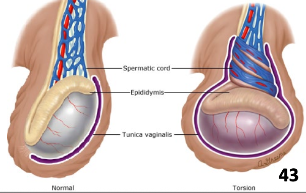 <ul><li><p>Urologic emergency where testis twists on spermatic cord</p><ul><li><p class="p2">More common in neonates than adults</p></li><li><p class="p2">Accounts for 25 – 50% of hospitalizations for acute scrotal pain</p></li></ul></li></ul><p></p>