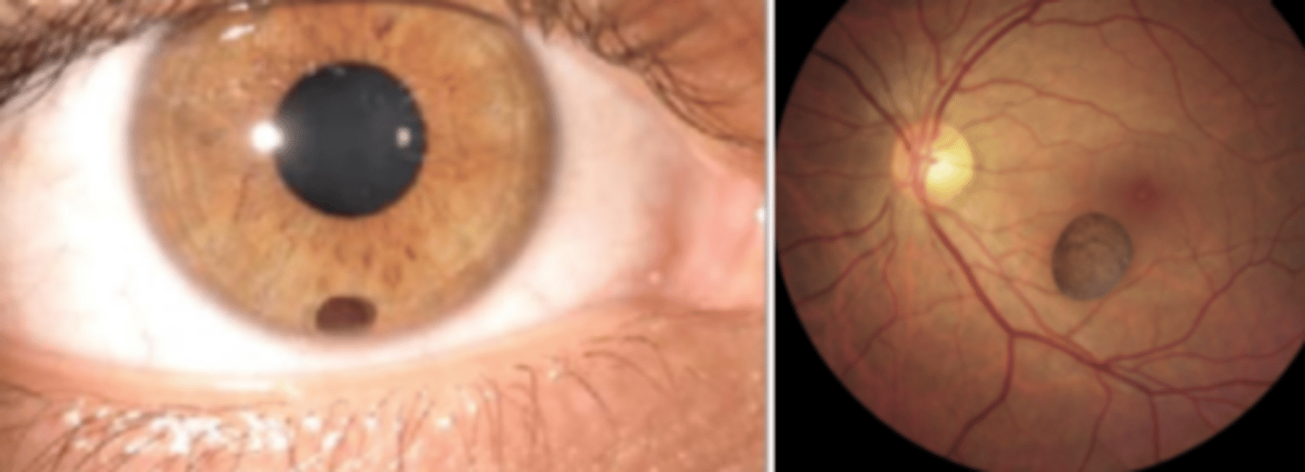 <p>primary iris cyst which is a dislodged pigment epithelial cyst. Do not transilluminate. Can dislodge anteriorly (asymptomatic) or posteriorly (mimic intraocular foreign bodies).</p>