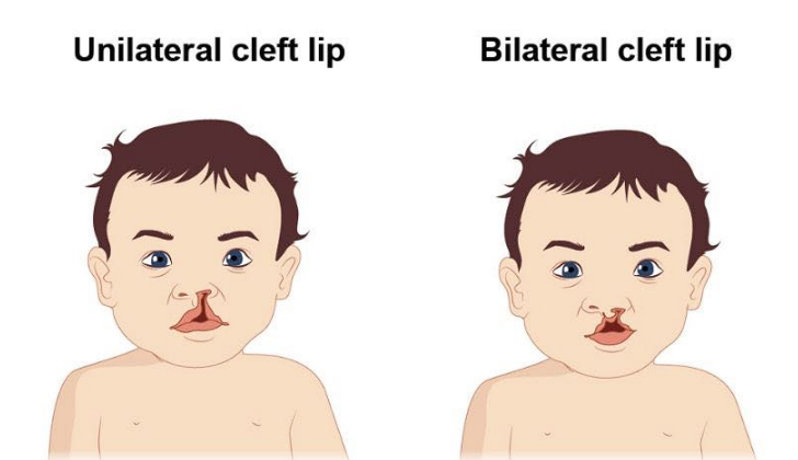 A congenital abnormality  where there is a slip, or  gap, in the upper lip on one  or both sides.