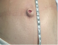 <p><strong>What condition presents with the following?</strong></p><ul><li><p>nodule in umbilicus</p></li><li><p>secondary ulceration of nodule</p></li><li><p>weight loss, early satiety, painless jaundice, enlarged node of Virchow</p></li><li><p><u>indicates advanced cancer w/in abdomen or pelvis</u></p></li></ul><p></p>
