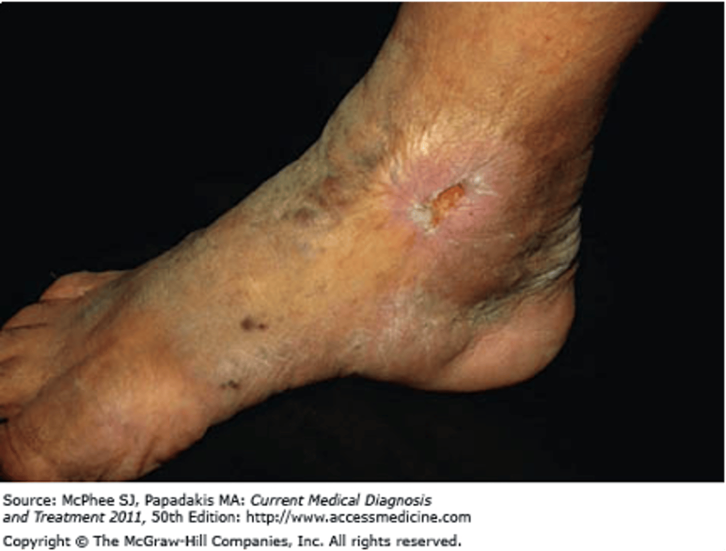 <p>Full-thickness loss of the epidermis with damage to the dermis</p><p>Important, especially in bed-bound patients.</p><p>May bleed and scar</p><p>- Ex: venous stasis ulcers, syphilitic chancre</p>
