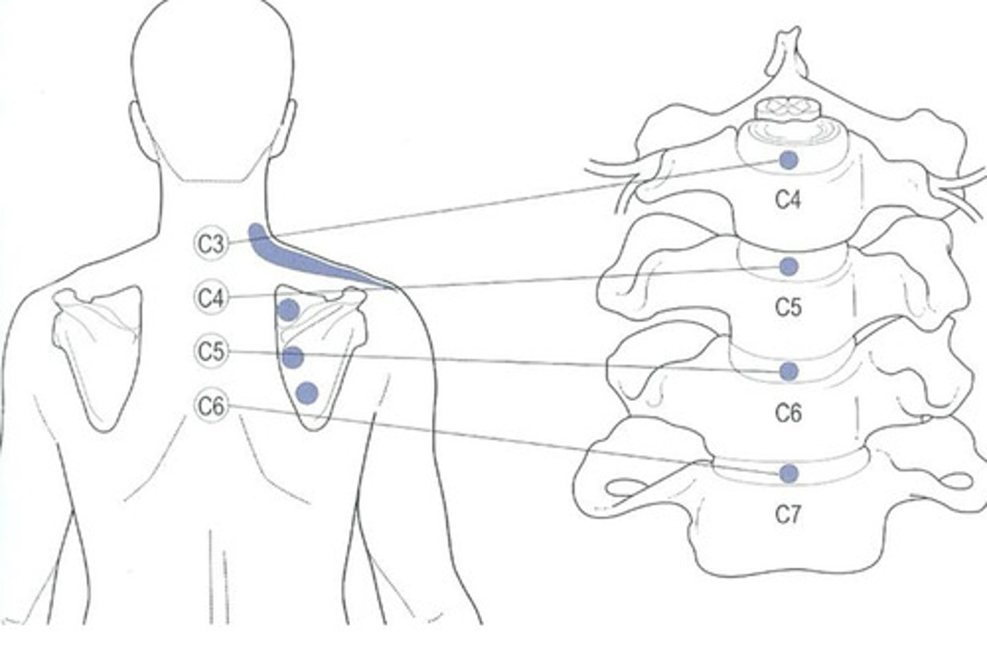<p>referred pain from cervical discs can be felt in the medial part of the scapula</p>