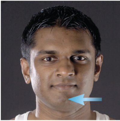 <p>movement of the mandible back toward the midline</p>