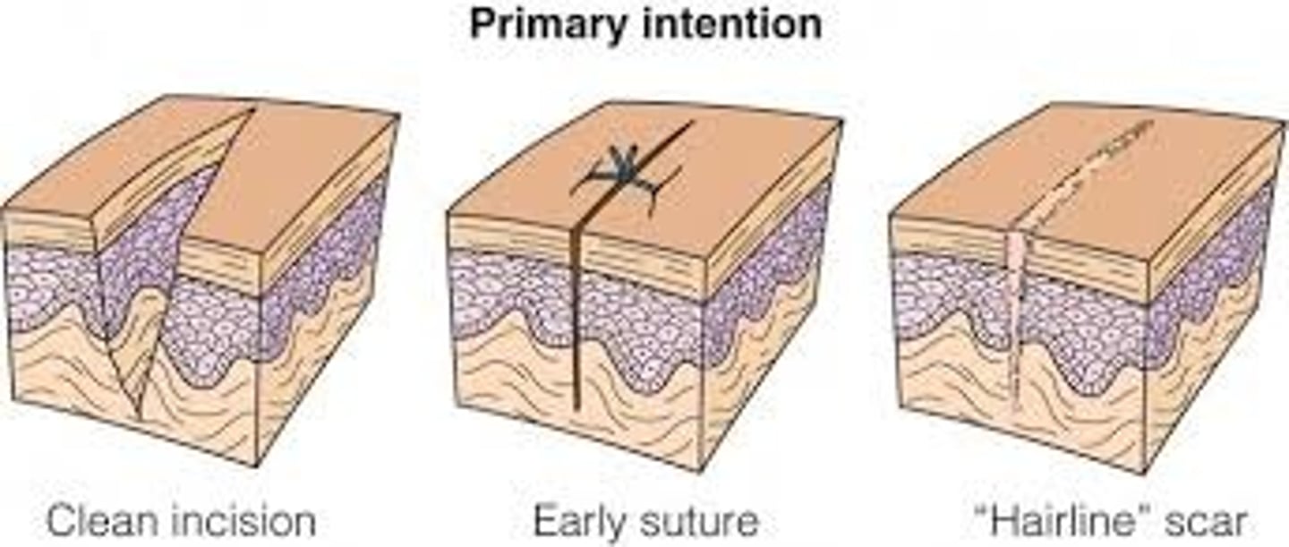 <p>Small, clean wounds that heal with little tissue loss</p>