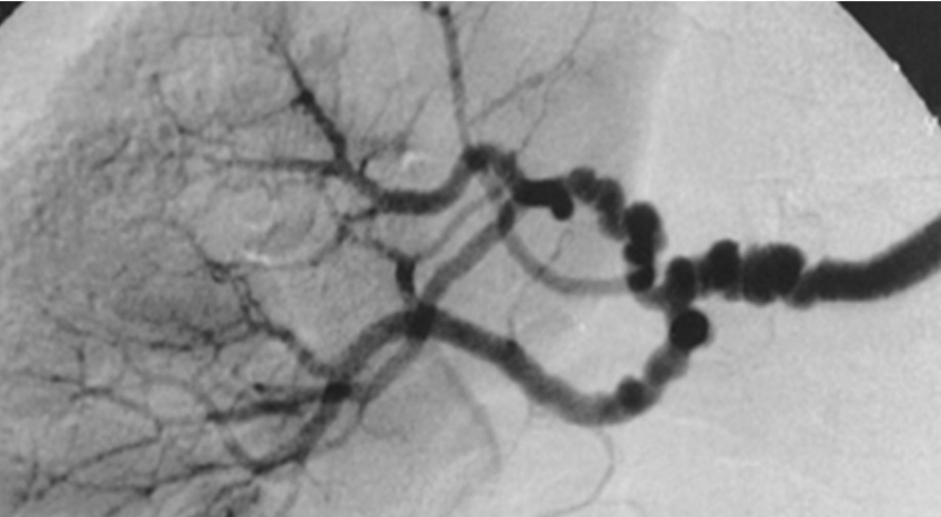 <p>Fibromuscular dysplasia</p>