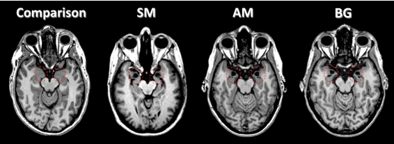 <ul><li><p>rare disorder in which lesions occur in bilateral (both) amygdala areas </p></li><li><p>gave p w/bilateral amygala damage co2 inhalation</p><ul><li><p>inhaled CO2 – method of inducing panic</p></li><li><p>Measured rates of panic attacks &amp; subjective fear/panic</p></li></ul></li><li><p>had an elevated panic response</p><ul><li><p>All the amygdala patients had panic attacks, only 25% of healthy controls did</p></li></ul></li><li><p>Consistent with earlier suggestions that panic is a false biological alarm, the affective response to CO2 may be part of a protective system triggered by suffocation and acute metabolic distress.</p><ul><li><p>they can experience panic </p></li></ul></li><li><p>Amygdala patients and controls who did have panic attacks had similar levels of subjective panic → capable to experience fear </p></li></ul><img src="https://knowt-user-attachments.s3.amazonaws.com/5ab5db6d-5b41-4919-9a82-4fe4deb49a13.png" data-width="100%" data-align="center"><p></p>