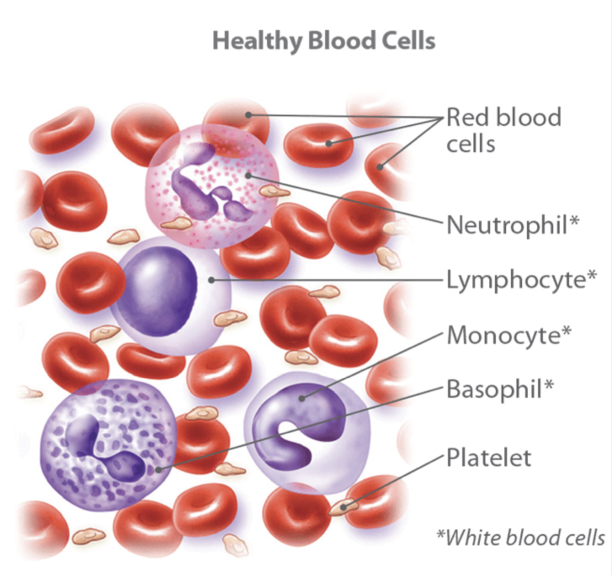 <p><strong><span>BLOOD CANCER</span></strong></p><p><strong><span>Three </span></strong><span>main types of blood cancers:</span></p><p><strong><span>Leukemia</span></strong><span>, a type of cancer found in your </span><strong><span>blood </span></strong><span>and </span><strong><span>bone marrow</span></strong><span>, is caused by the rapid production of abnormal white blood cells. The high number of abnormal white blood cells are not able to fight infection, and they impair the ability of the bone marrow to produce red blood cells and platelets.</span></p><p><strong><span>Lymphoma </span></strong><span>is a type of blood cancer that affects </span><strong><span>the lymphatic system</span></strong><span>, which removes excess fluids from your body and produces immune cells. Lymphocytes are a type of white blood cell that fight infection. Abnormal lymphocytes become lymphoma cells, which multiply and collect in your lymph nodes and other tissues. Over time, these cancerous cells impair your immune system.</span></p><p><strong><span>Myeloma </span></strong><span>is a type of blood cancer that specifically targets your </span><strong><span>plasma cells</span></strong><span>. Plasma cells are white blood cells that produce disease- and infection-fighting antibodies in your body (B-lymphocytes). Myeloma cells prevent the normal production of antibodies, leaving your body’s immune system weakened and susceptible to infection.</span></p>