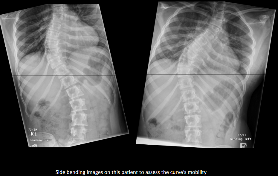 <p>Structural scoliosis does not correct with side bending; non-structural scoliosis to a reasonable extent corrects.</p>
