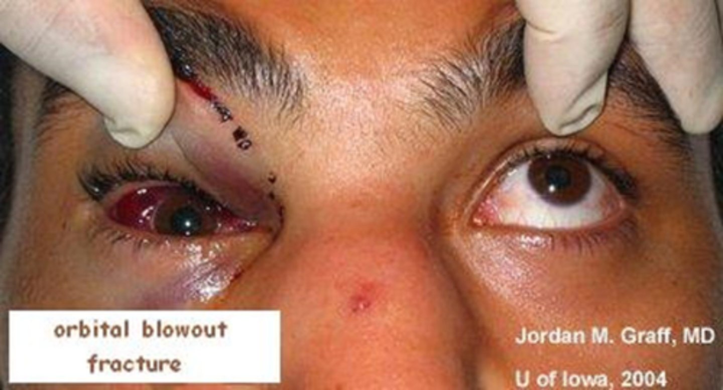 <p><u>Etio</u>: traumatic deformity of orbital floor or medial wall, Hx significant blunt trauma</p><p><u>S&amp;S</u>: pain occurs w/ eye movement, diplopia, swelling, <strong>enophthalmos</strong>, point tenderness, numbness of upper lip/cheek, EOMs restricted</p><p><u>Diagnostic Studies</u>: immediate CT Scan, must r/o ruptured eye <strong>(<mark data-color="#fff500" style="background-color: #fff500; color: inherit">positive Seidel's sign)</mark></strong></p><p><u>Tx</u>: <strong><u>1st line</u></strong>: <strong><mark data-color="#eaff00" style="background-color: #eaff00; color: inherit">Augmentin 600 mg IV or 875 mg BID, OR Azithromycin 500 mg or 1g IV</mark>, </strong>emergent consult to ophthalmology</p>