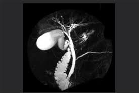 <p>MRCP Advantages </p><ul><li><p>Detailed anatomy - can detect head of pancreas mass and for cholecystitis </p></li><li><p>Higher sensitivity for Choledocholithiasis </p></li><li><p>Not limited by gas, bone or most habitus </p></li><li><p>No ionising radiation </p></li></ul><p></p>