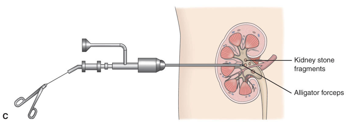 <p></p><ul><li><p>Nephroscope is introduced percutaneously to the renal parechyma,</p></li><li><p>depending on the size, the stone is extracted via forceps or retrieval basket</p></li></ul>