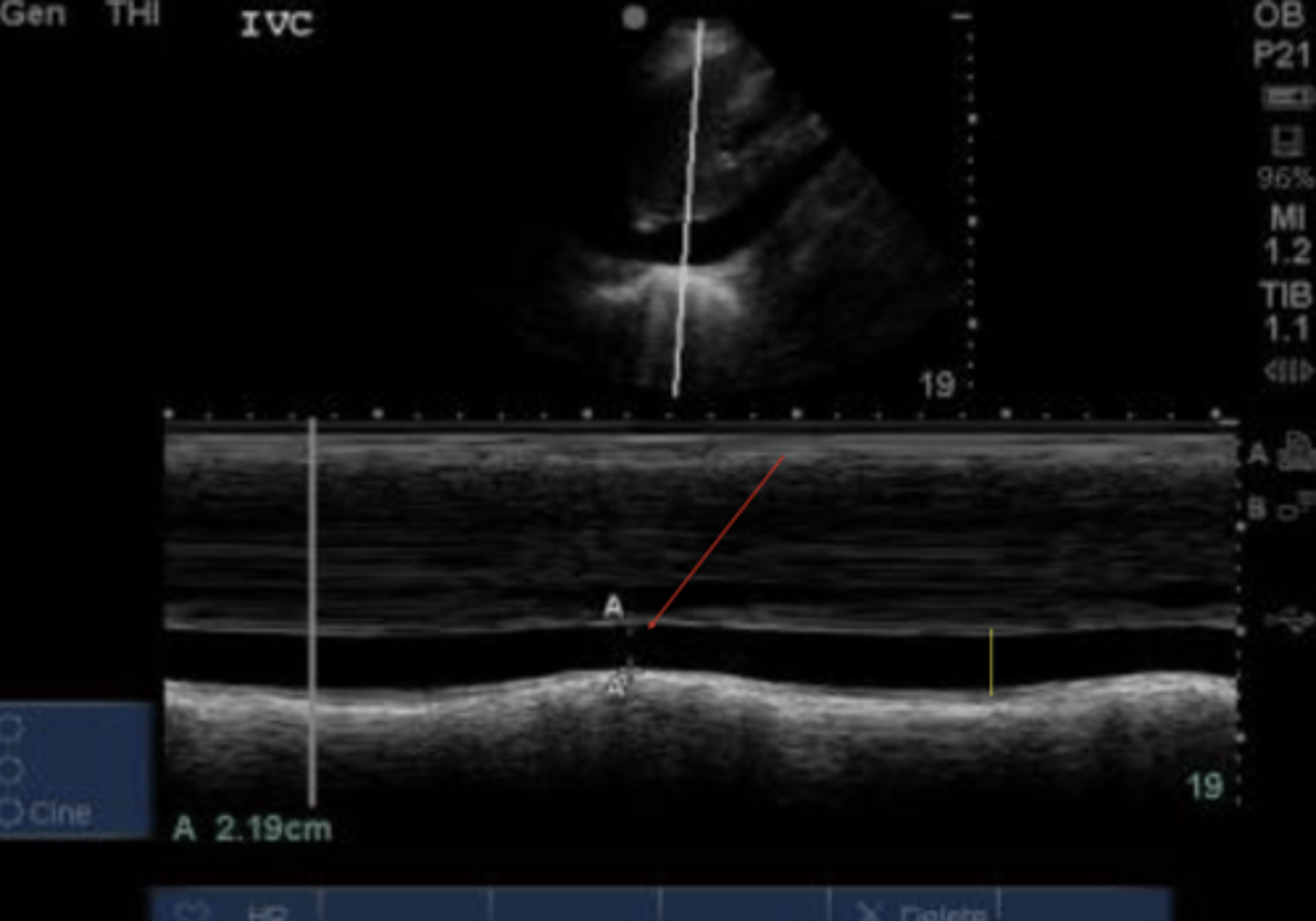 <p>IVC collapse</p><p>= RVDP</p>