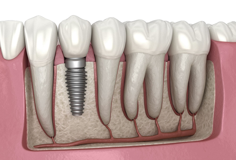 <p>For restorations, prosthetics implants, instruments</p>