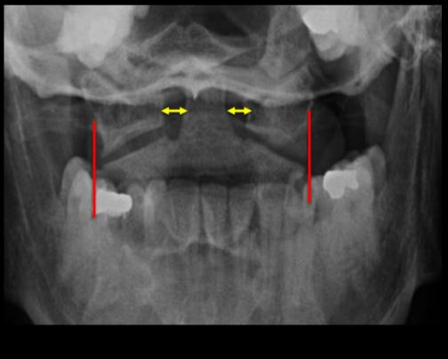 <p>What should antlantoaxial joints appear like in a radiograph?</p>