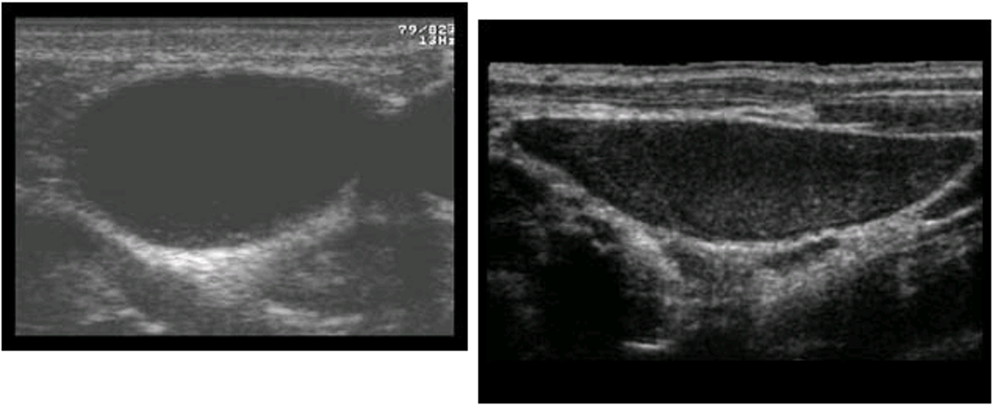 <p>remnant of embryonic development that appears as a cyst in the lateral neck</p>