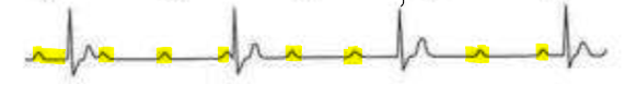 <p>What rhythm is likely present on the following ECG trace?</p>