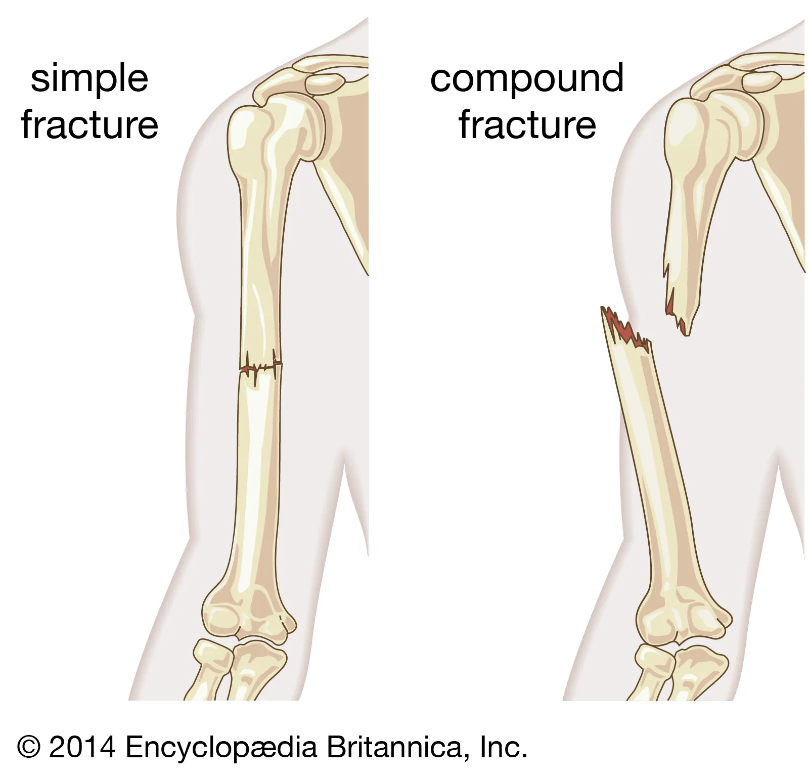 <p>Broken Bone</p><ul><li><p>S/S:  pain &amp; tenderness, swelling, loss of function/mobility</p></li><li><p>Dx:  X-ray</p></li><li><p>Tx:  Splint, Reduction with Fixation Device (closed or open), Immobilization, rehab</p></li></ul><p></p>