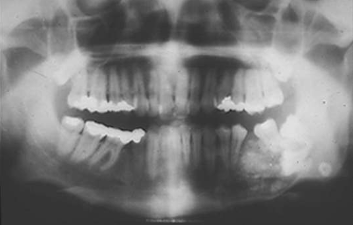 <p>T/F: you can see B/L expansion in this radiograph </p>