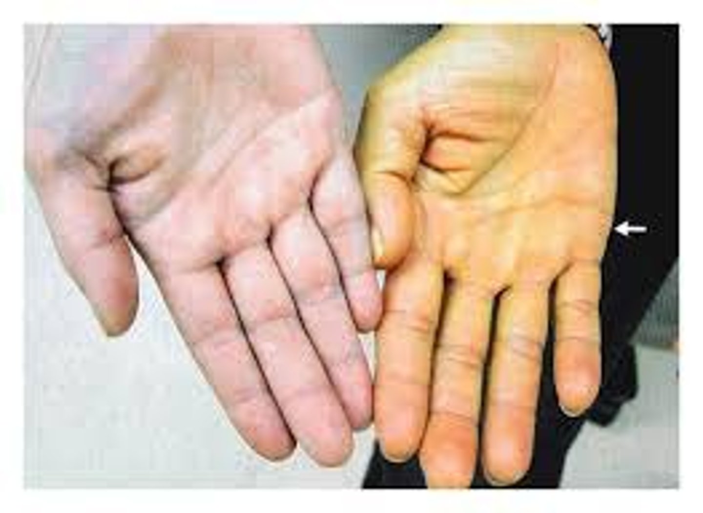 <p>yellow to orange pigment; most obvious in palms and soles; accumulates in stratum corneum and hypodermis; can be converted to vitamin A for vision and epidermal health</p>