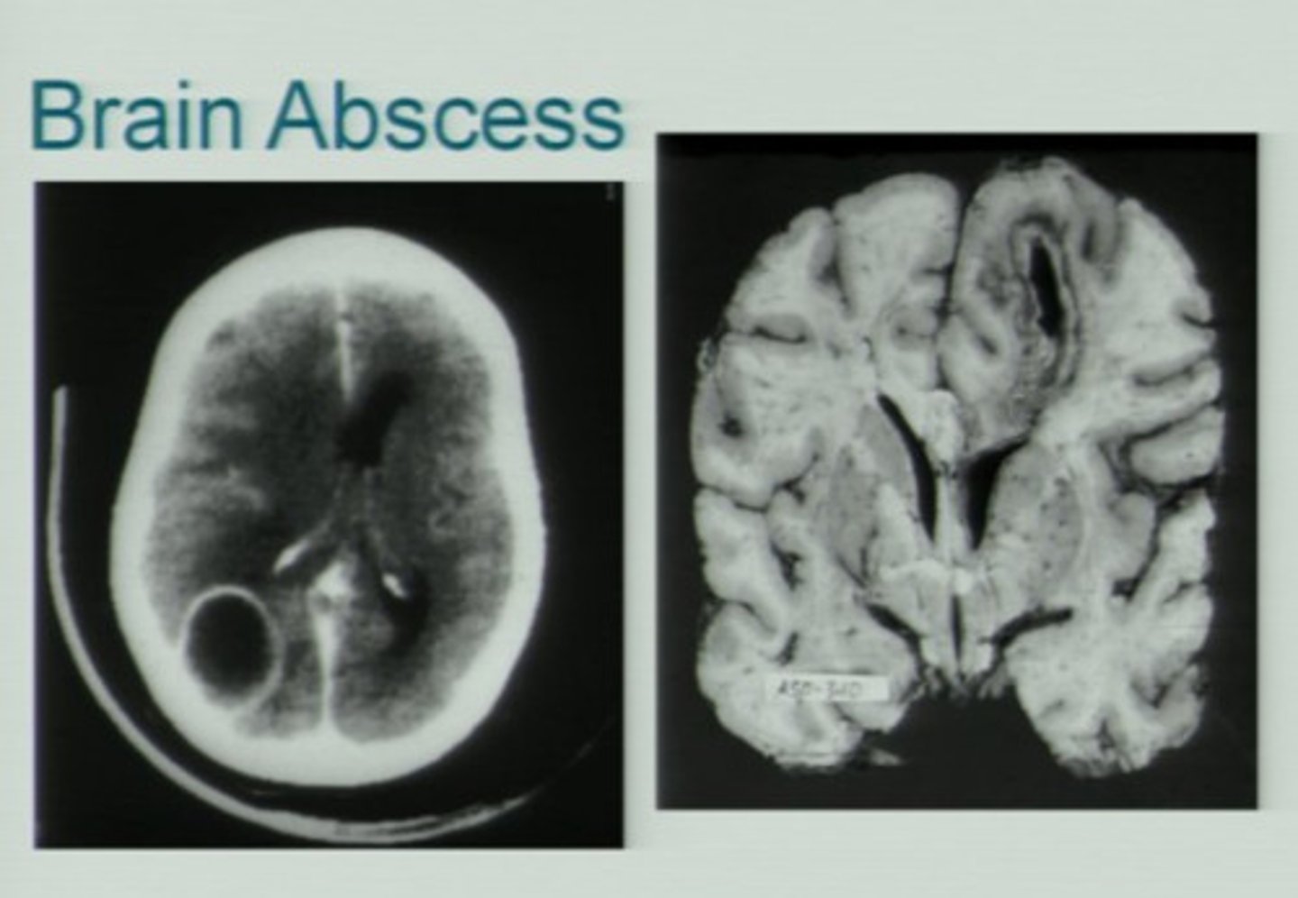 <p>Brain abscess formation</p><p>- Ring-enhancing lesion on CT or MRI</p>
