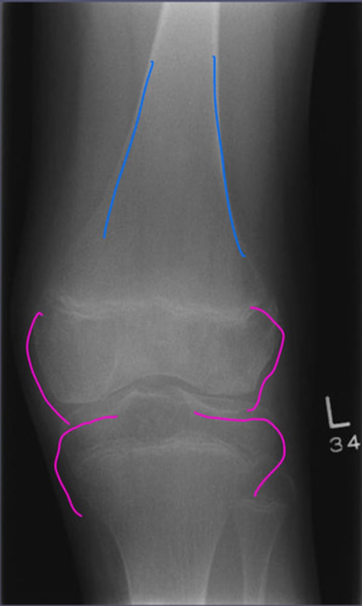 <p>What is the condition with an enlargement of the distal femoral epiphysis?</p>