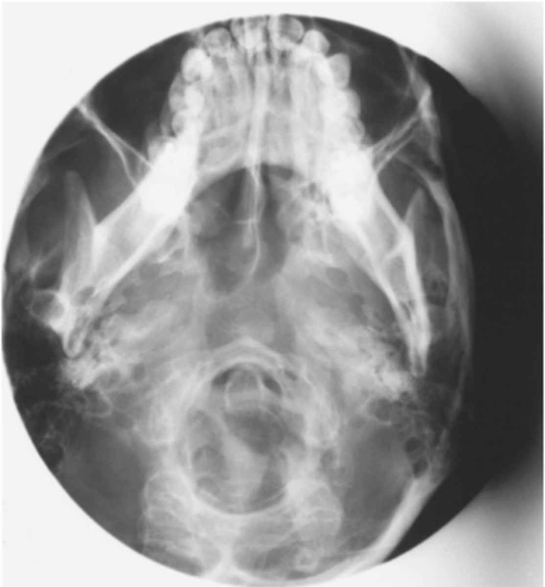 <p>Repeatable errors (four)—</p><p>Criterion 1: Anatomy demonstrated: Maxillary and ethmoid sinuses are not well demonstrated because of superimposition of mandible. </p><p>Criterion 2: Positioning: The skull is grossly underextended and tilted (also slight rotation). </p><p>Criterion 3: Collimation and CR: Collimation would have been adequate if centering had been correct. CR centering is off laterally, leading to cutting off of the anatomy. Mandible is superimposed over sinuses. </p><p>Criterion 5: Anatomic side markers: No anatomic side marker is visible.</p>