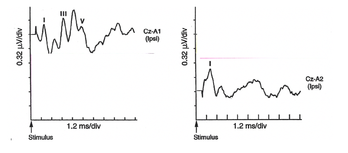 <p><span style="background-color: transparent;"><span>The ABR responses (80 dBnHL) below were obtained from a 56-year-old male with normal hearing in the left ear and gradually worsening mild high-frequency sensory-neural hearing loss in the right ear.</span></span></p><p><span style="background-color: transparent;"><span>I: Discuss the ABR test findings for each ear.</span></span></p><p><span style="background-color: transparent;"><span>II: If any of the findings are abnormal, discuss the possible site of the lesion.</span></span></p><p><span style="background-color: transparent;"><span>&nbsp;</span></span></p>