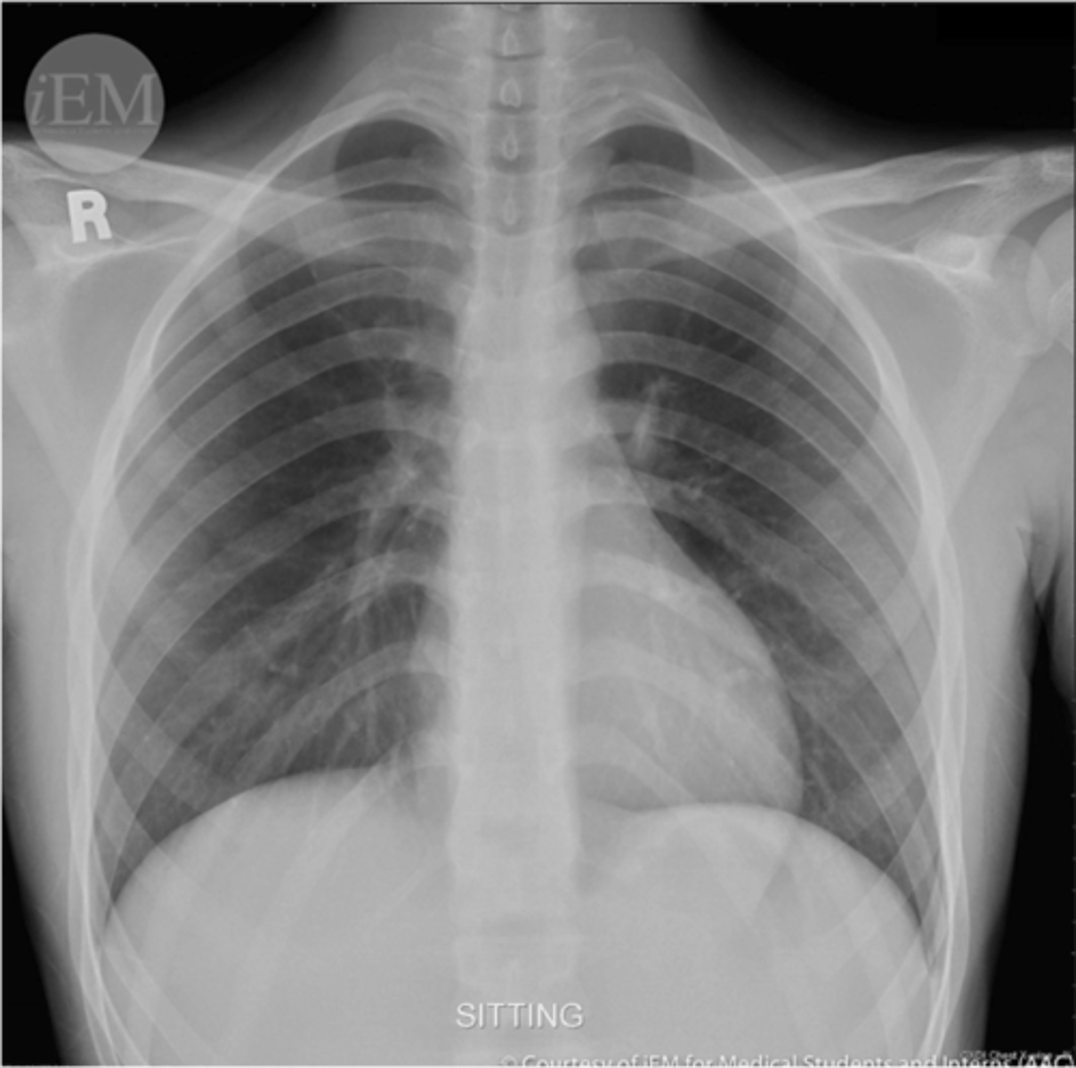 <p>-look for nodes or vasculature on the hila of both lungs</p><p>-left hila should be higher</p>