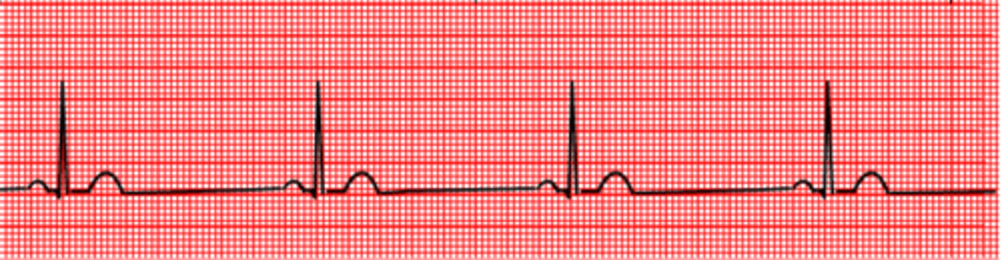 <p>What will sinus bradicardia going to look like on ECG?</p>
