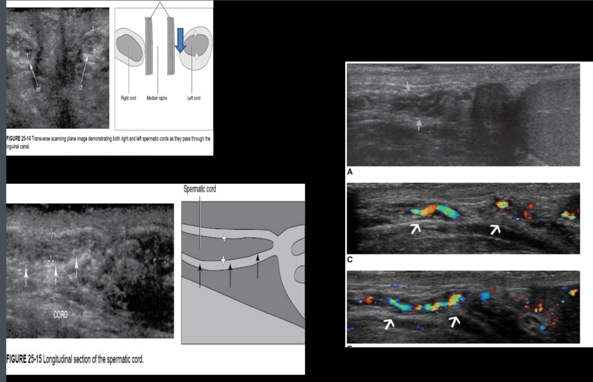 <p>What does the spermatic cord consist of?</p>