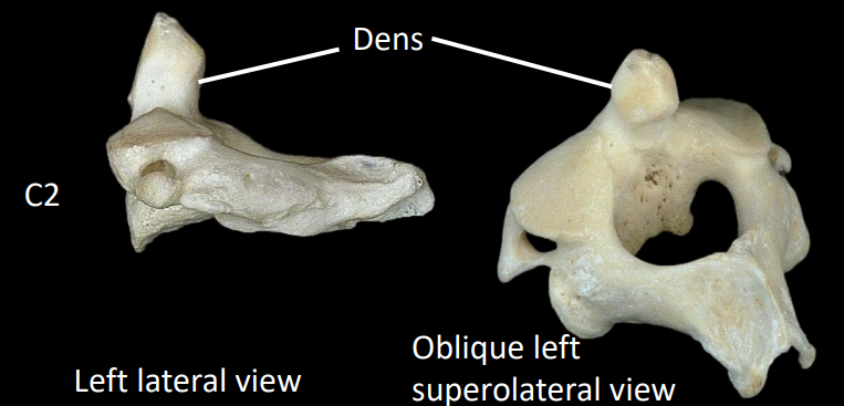 <p>dens/odontoid process - “stolen” body of C1</p><ul><li><p>forms the atlantoaxial joint that allows for rotation of the head</p></li></ul><p></p>