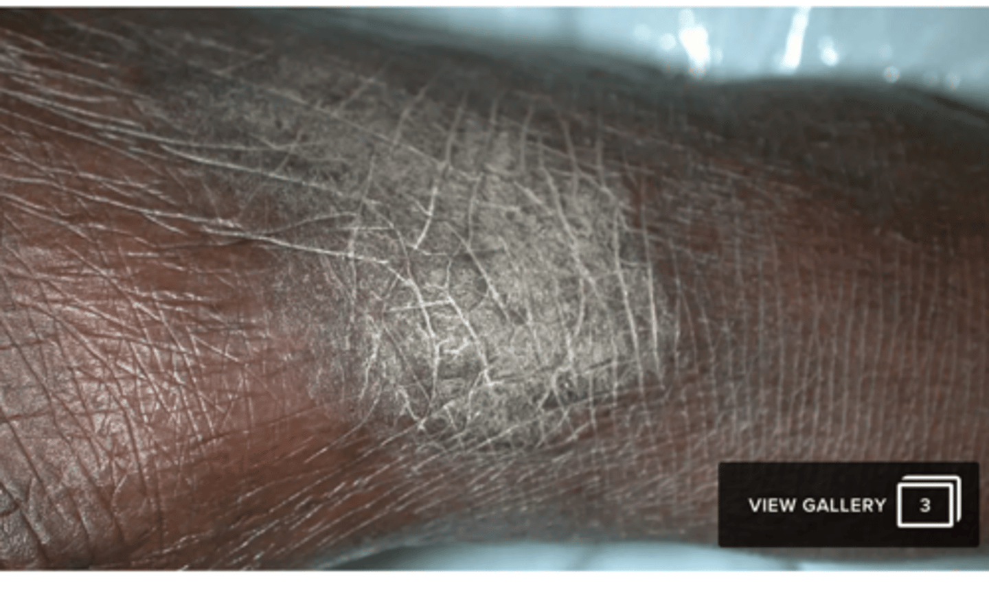 <p>•Inflammatory dermatosis characterised by erythema (redness of skin) and pruritus (itch)</p><p>- usually in the flexural surfaces, in babies usually presents on the face</p><p>can result in lichenification (pic)</p>