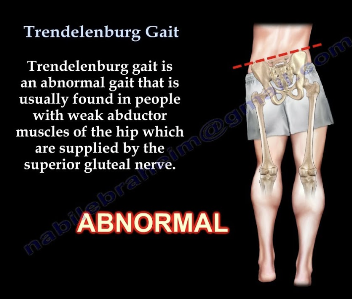 <p><strong>Impairment:</strong> <span style="color: blue">Gluteus medius weakness</span> of the stance leg<br><strong>Deviation/Compensation:</strong> <span style="color: red">Trendelenburg gait</span> — contralateral pelvis drops</p>