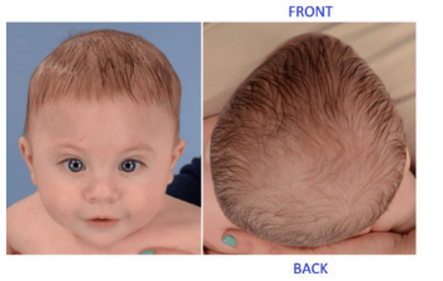 <p>premature metopic (frontal) suture fusion resulting in a high, retreating, triangular forehead. Is also associated with hypotelorism due to migration of the eyes following cranium growth.</p>