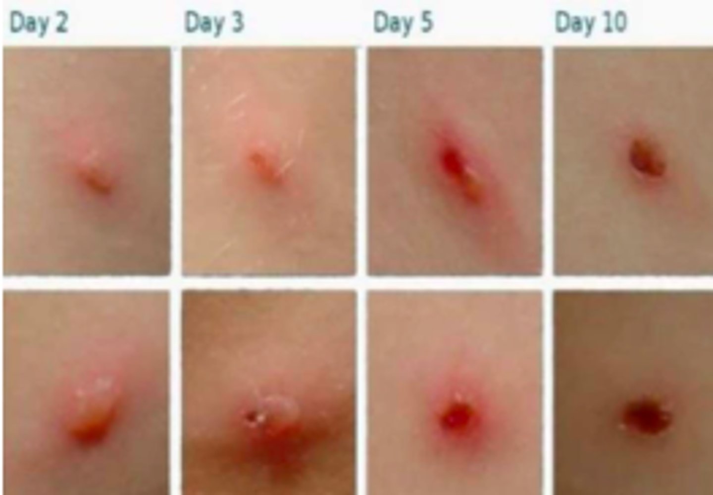 <p>Viral ID:</p><p>Objective:</p><p>Lesions:</p><p>- Begin as macules that rapidly become papules following by characteristic vesicles (“dew drops on rose petal”)</p><p>- Can then development pustular component followed by the formation of crusted papules</p><p>-Crusts tend to fall off within 1-2 weeks &amp; leave a temporary area of hypopigmentation in the skin</p><p>- May lead to scarring</p><p>Vesicular lesions on an erythematous base!</p>