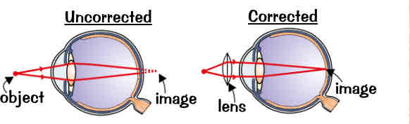 <ul><li><p>Long-sighted people are unable to focus on near objects:</p><ol><li><p>occurs when lens is the wrong shape &amp; doesn’t refract (bend) light enough or the eyeball is too short</p></li><li><p>images of near objects are brought into focus behind the retina</p></li><li><p>you can use glasses with a convex lens (lens which curves outwards) to correct it. The lens refracts the light rays so they focus on the retina</p></li><li><p>medical terma for long-sightedness → hyperopia</p></li></ol></li></ul>