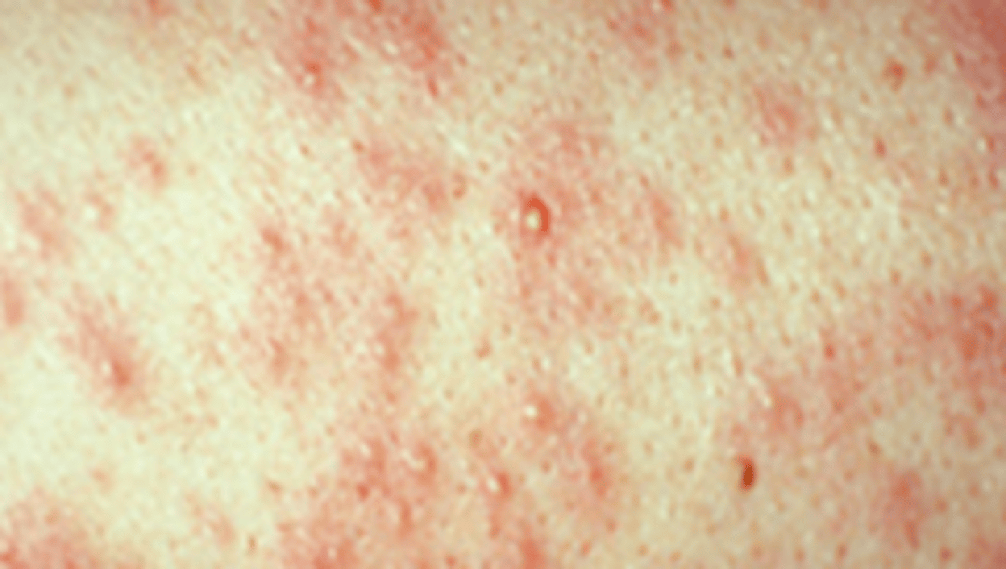 <p>heat rash from sweat gland obstruction</p><p>avoid overheating/overdressing</p>
