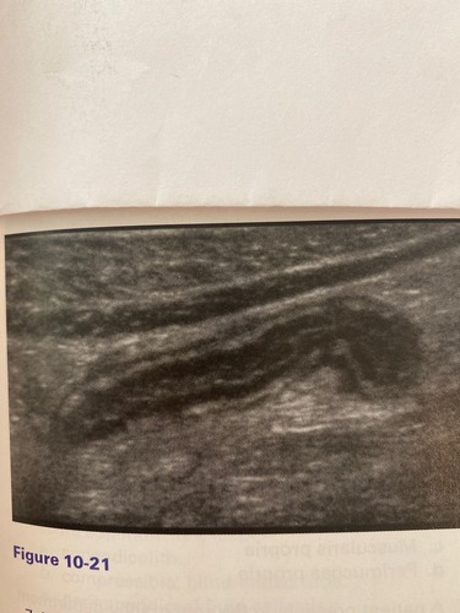 <p>The patient in Figure 10-21 presented with right lower quadrant pain and nausea. The anteroposterior measurement of this structure in this image should not exceed:</p><p>a. 4 mm.</p><p>b. 3 mm.</p><p>c. 10 mm.</p><p>d. 6 mm.</p>