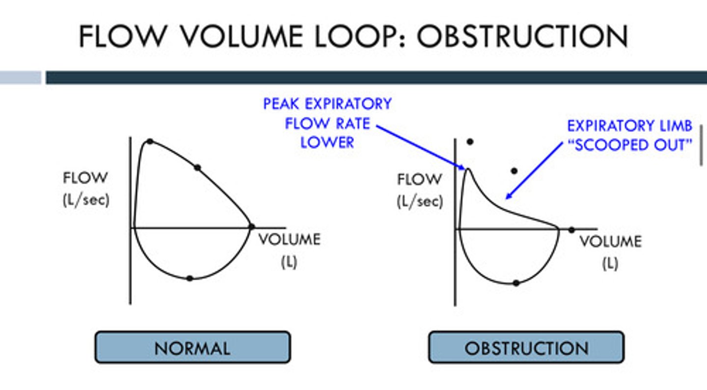 <p>A <strong>scooped out</strong> shape or a concave exhalation curve due to a <strong>lower</strong> peak expiratory flow rate and narrowed or blocked airways. It make it harder to push air out <strong>quickly</strong>, especially during the middle and later parts of exhalation</p>