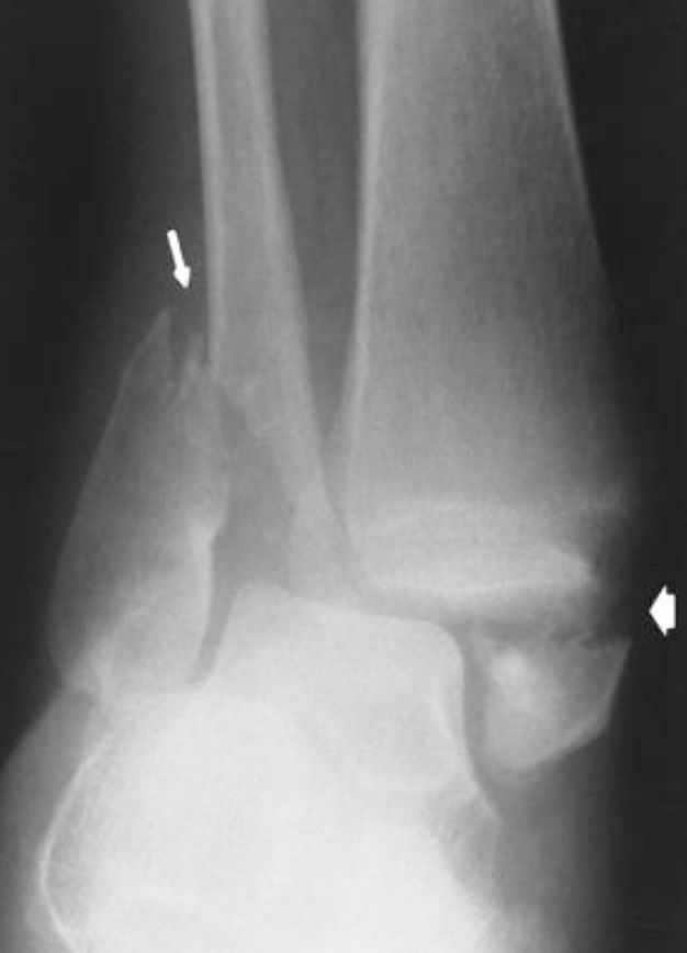 <p>Name this fracture (has two names)</p>