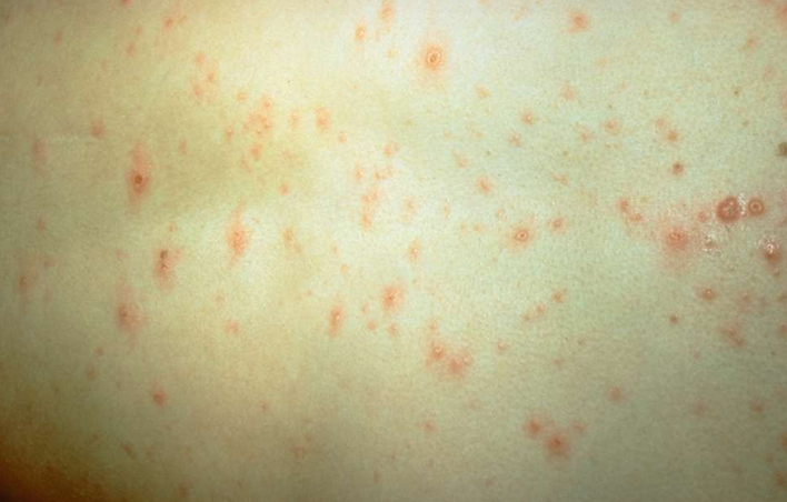 <p>Welke infectie is dit? (tip : genavelde blaasjes)</p>
