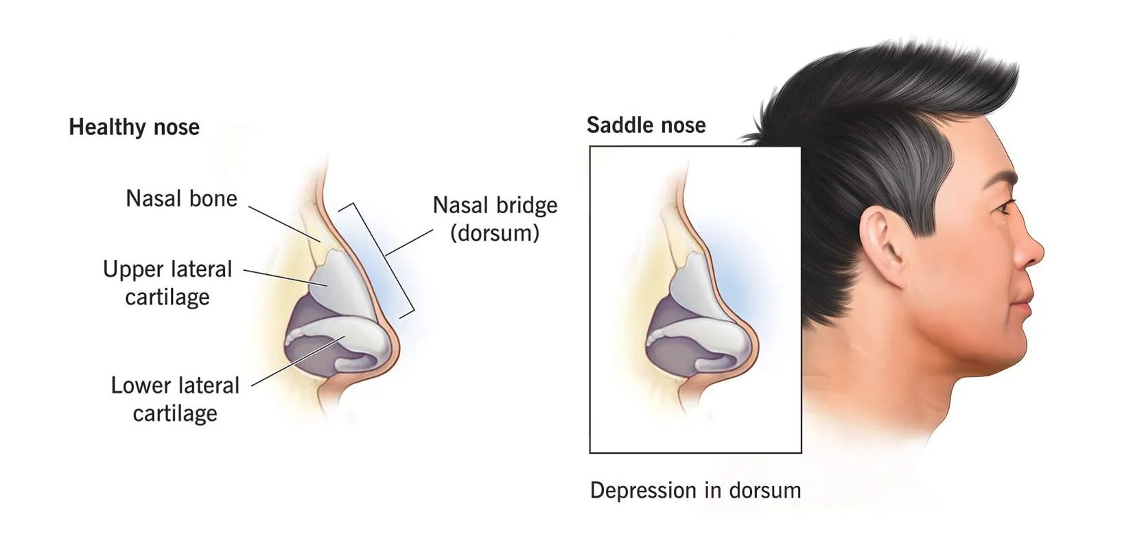 <p>involves the dorsum of the nose. cartilage or bone or both</p><p>causes; HOT SALT<br>Haematoma, operative,trauma, syphilis, abscess,leprosy , tuberculosis</p><p>Correction-augmentation rhinoplasty</p>