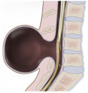 <p>What type of spina bifida is this? </p>