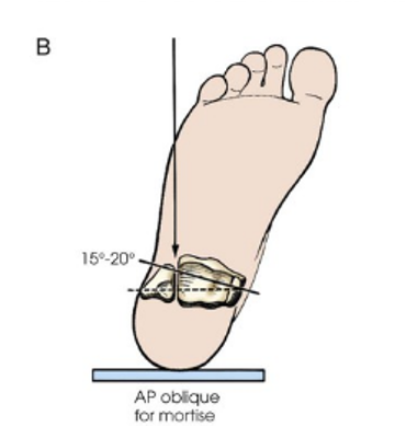 <p>AP Oblique for mortise</p>