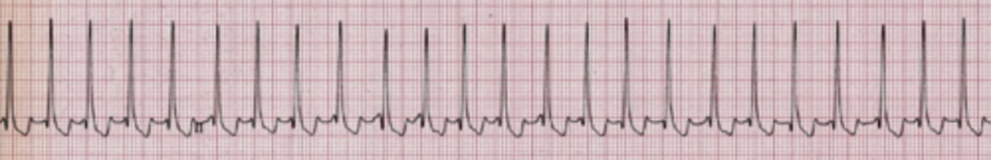 <p>Identify the tachyarrhythmia.</p>